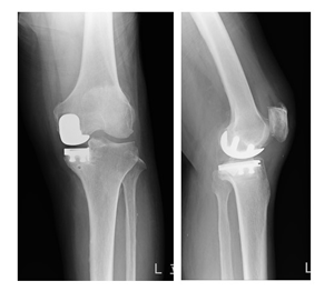 単顆型人工膝関節置換術